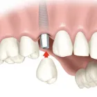 Business 3 image AFFORDABLE DENTAL IMPLANTS ALBANY Dentists in Delmar NY