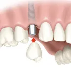 Business 4 image AFFORDABLE DENTURES ALBANY Dentists in Delmar NY