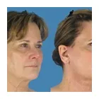 Business 1 image AVANTE PLASTIC SURGERY Tummy Tuck in Houston TX