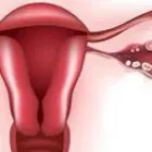Business 2 image FIBROIDS TREATMENT AND REMOVAL in Brooklyn NY