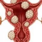Business 4 image FIBROIDS TREATMENT AND REMOVAL in Brooklyn NY