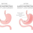 Business 6 image GASTRIC SLEEVE SURGERY Physicians & Surgeons, Surgery-General in Brooklyn NY
