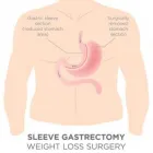 Business 1 image GASTRIC SLEEVE SURGERY Physicians & Surgeons, Surgery-General in Brooklyn NY