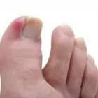 Business 2 image INGROWN TOENAIL THERAPY in Los Angeles CA