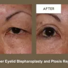Business 9 image KLAPPER EYELID AND FACIAL PLASTIC SURGERY Plastic Surgery in Indianapolis IN