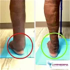 Business 1 image LYMPHEDEMA THERAPY SPECIALISTS Medical Clinics in Houston TX
