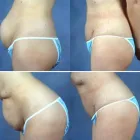 Business 7 image PETER B FODOR MD, FACS Tummy Tuck in Los Angeles CA