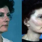 Business 10 image PETER B FODOR MD, FACS Tummy Tuck in Los Angeles CA