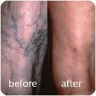 Business 17 image ST LOUIS LASER VEIN CENTER in St. Louis MO