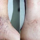 Business 27 image ST LOUIS LASER VEIN CENTER in St. Louis MO