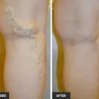Business 45 image ST LOUIS LASER VEIN CENTER in St. Louis MO