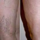 Business 57 image ST LOUIS LASER VEIN CENTER in St. Louis MO