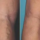 Business 58 image ST LOUIS LASER VEIN CENTER in St. Louis MO