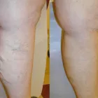 Business 97 image ST LOUIS LASER VEIN CENTER in St. Louis MO
