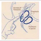 Business 3 image THE PROSTATE SEED INSTITUTE Cancer Treatment Centers in Irving TX