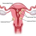 Business 3 image USA FIBROID CENTERS Womens Health in Brooklyn NY