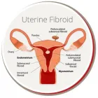 Business 1 image USA FIBROID CENTERS Uterine Fibroid Removal in Arlington TX