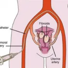Business 3 image USA FIBROID CENTERS Uterine Fibroid Removal in Arlington TX