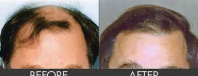 Business 2 image MAXIM HAIR RESTORATION Hair Transplant in Houston TX