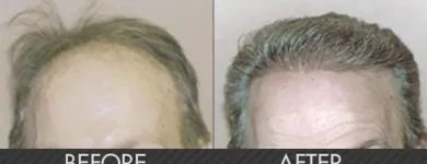 Business 3 image MAXIM HAIR RESTORATION Hair Transplant in Houston TX