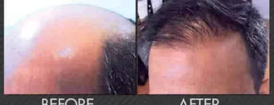 Business 4 image MAXIM HAIR RESTORATION Hair Transplant in Houston TX