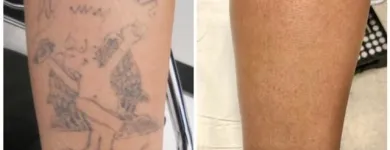 Business 6 image MEDERMIS LASER CLINIC in San Antonio TX