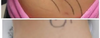 Business 11 image MEDERMIS LASER CLINIC in San Antonio TX