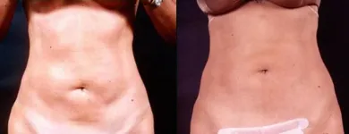 Business 6 image PETER B FODOR MD, FACS Tummy Tuck in Los Angeles CA