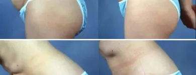 Business 7 image PETER B FODOR MD, FACS Tummy Tuck in Los Angeles CA