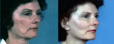 Business 10 image PETER B FODOR MD, FACS Tummy Tuck in Los Angeles CA