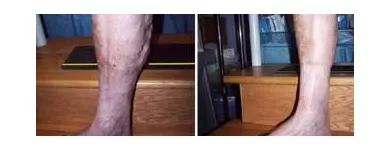 Business 4 image ST LOUIS LASER VEIN CENTER in St. Louis MO