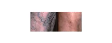 Business 17 image ST LOUIS LASER VEIN CENTER in St. Louis MO