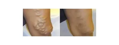 Business 31 image ST LOUIS LASER VEIN CENTER in St. Louis MO