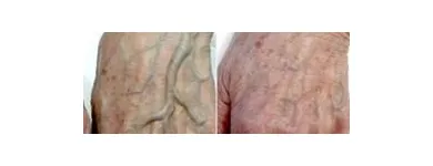 Business 32 image ST LOUIS LASER VEIN CENTER in St. Louis MO
