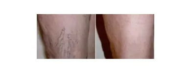 Business 33 image ST LOUIS LASER VEIN CENTER in St. Louis MO
