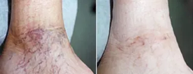 Business 35 image ST LOUIS LASER VEIN CENTER in St. Louis MO