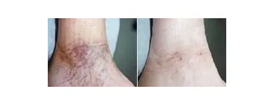 Business 37 image ST LOUIS LASER VEIN CENTER in St. Louis MO