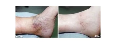 Business 44 image ST LOUIS LASER VEIN CENTER in St. Louis MO