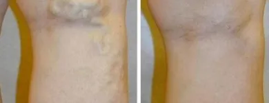Business 45 image ST LOUIS LASER VEIN CENTER in St. Louis MO