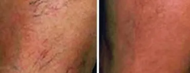 Business 53 image ST LOUIS LASER VEIN CENTER in St. Louis MO