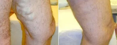 Business 55 image ST LOUIS LASER VEIN CENTER in St. Louis MO