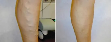 Business 56 image ST LOUIS LASER VEIN CENTER in St. Louis MO