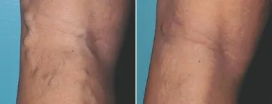 Business 58 image ST LOUIS LASER VEIN CENTER in St. Louis MO