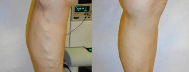 Business 67 image ST LOUIS LASER VEIN CENTER in St. Louis MO