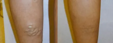 Business 68 image ST LOUIS LASER VEIN CENTER in St. Louis MO