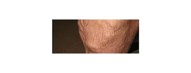 Business 75 image ST LOUIS LASER VEIN CENTER in St. Louis MO