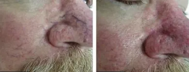 Business 76 image ST LOUIS LASER VEIN CENTER in St. Louis MO