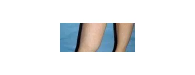 Business 79 image ST LOUIS LASER VEIN CENTER in St. Louis MO