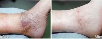 Business 81 image ST LOUIS LASER VEIN CENTER in St. Louis MO
