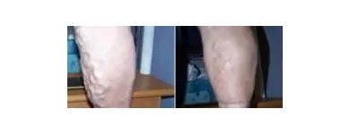 Business 99 image ST LOUIS LASER VEIN CENTER in St. Louis MO